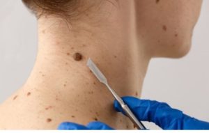 Prefeitura de Cáceres amplia atendimento dermatológico e realiza mutirão de pequenas cirurgias